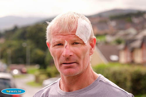 Padraig Lynch with injuries sustained during the assault. Photograph: Columba O'Hare 